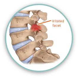 Mechanical Back Pain