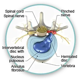 Neurological Back Pain