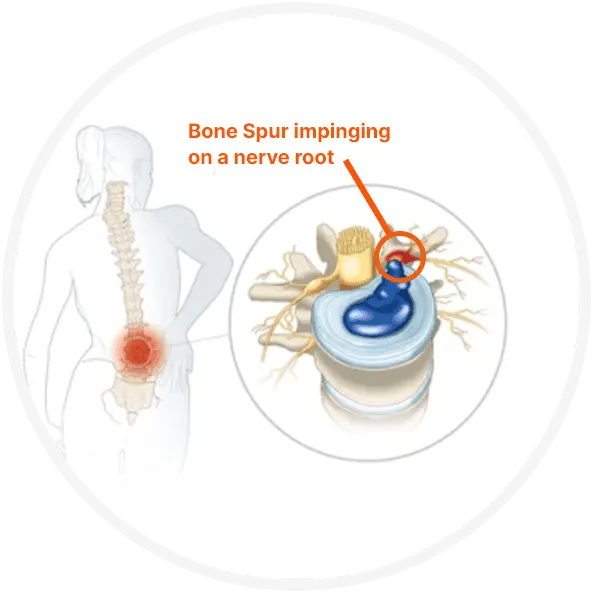 Bone Spur impinging on a nerve root